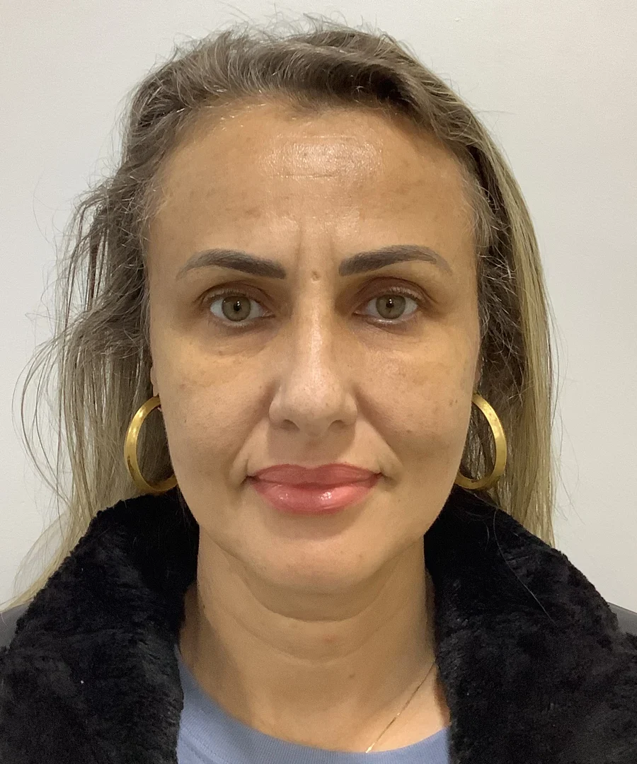 Fotona Melasma Treatment, after treatment
