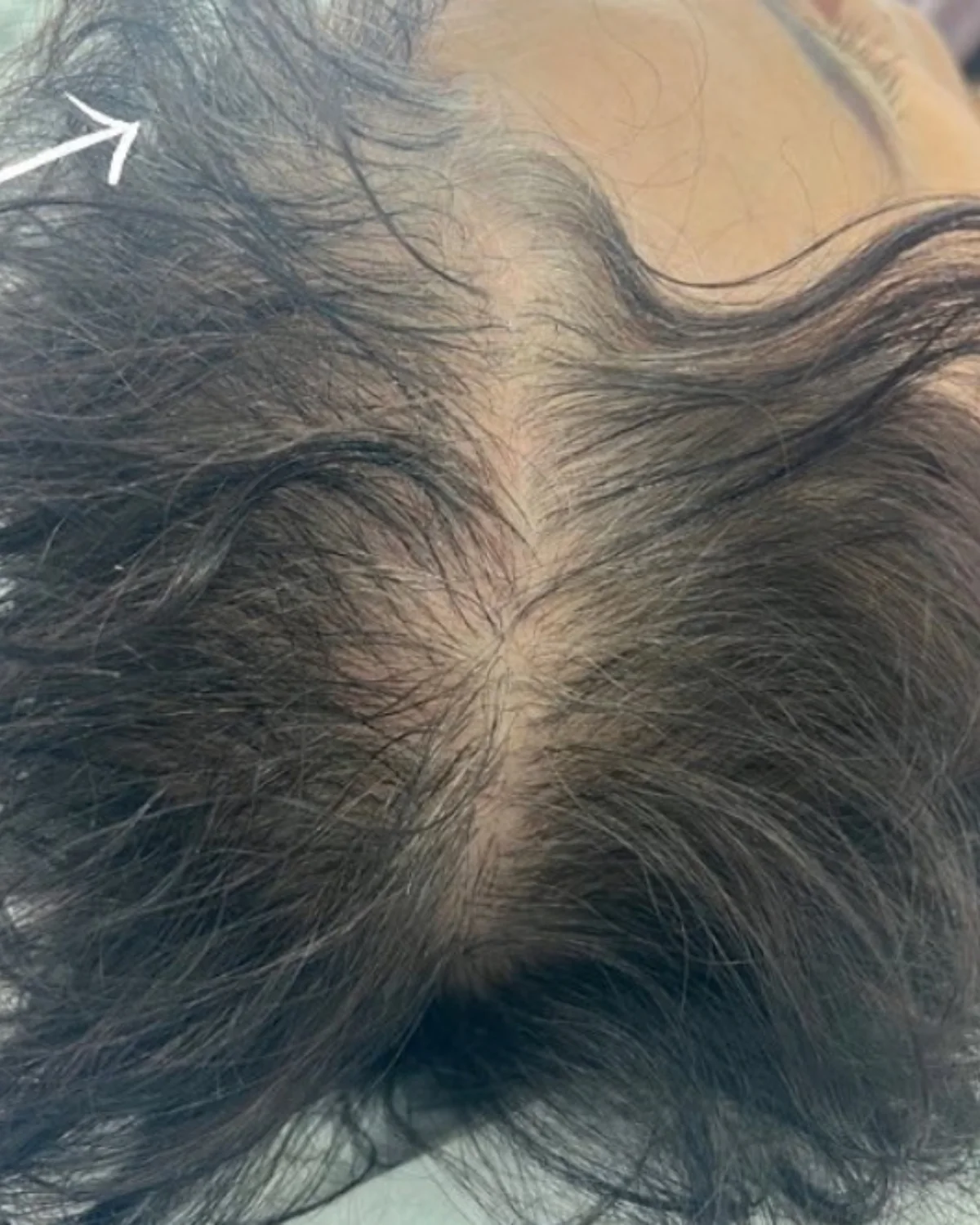 PRFM Hair Restoration after treatment at Advanced Aesthetics, Medford and Braintree MA
