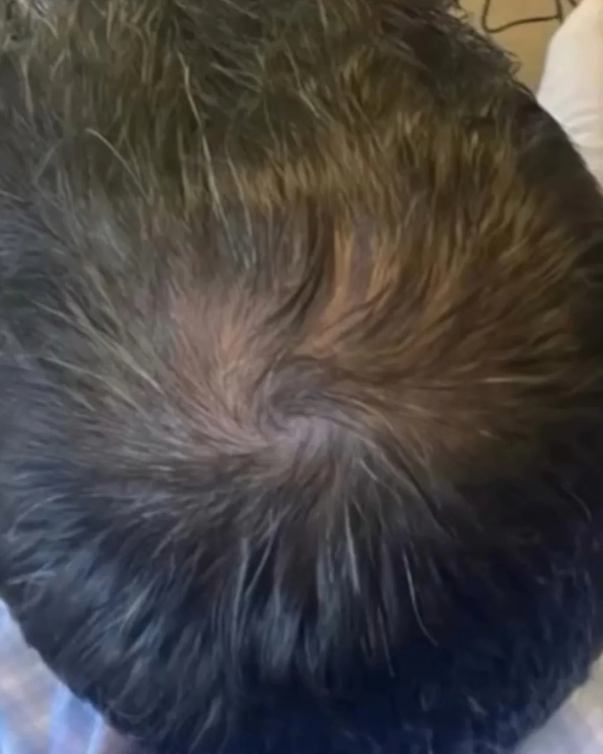 PRP Hair Treatment after treatment at Advanced Aesthetics, Medford and Braintree MA