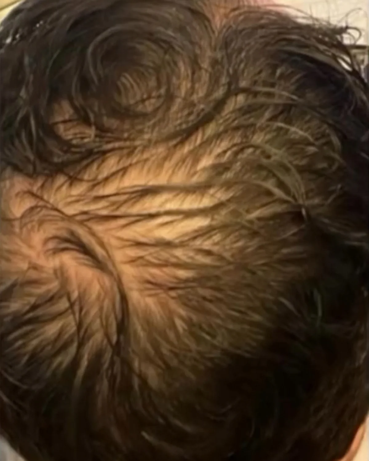 PRP Hair Treatment before treatment at Advanced Aesthetics, Medford and Braintree MA