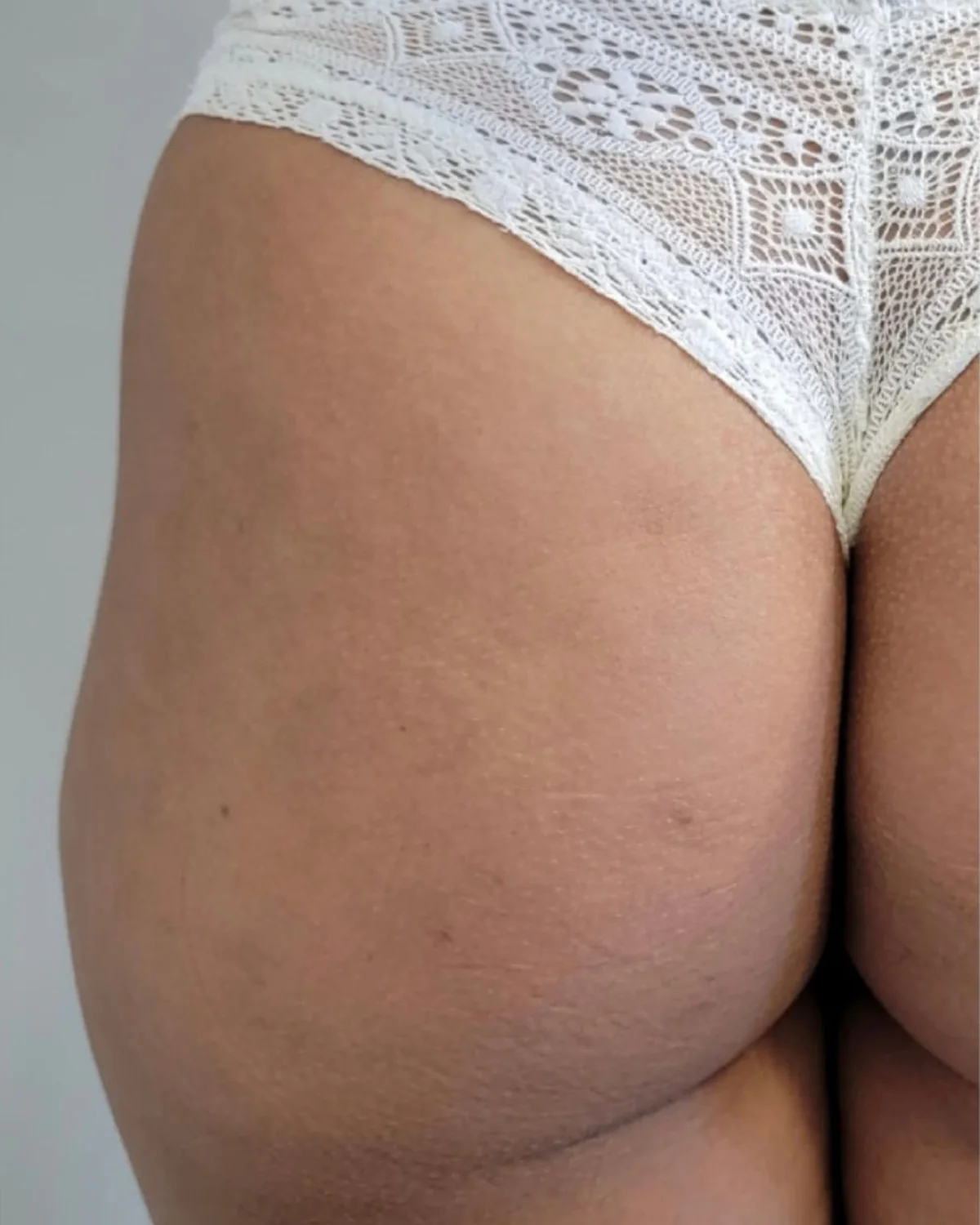 Sculptra Gluteal Enhancement after treatment at Advanced Aesthetics, Medford and Braintree MA