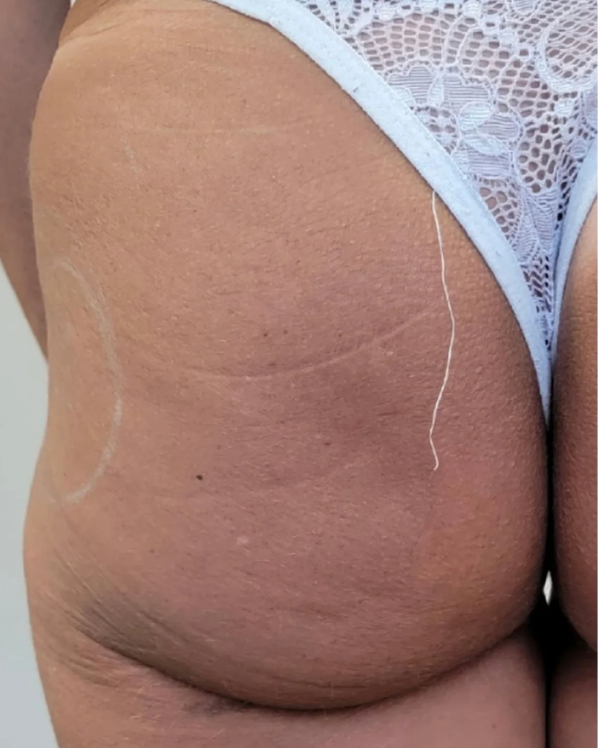 Sculptra Gluteal Enhancement before treatment at Advanced Aesthetics, Medford and Braintree MA