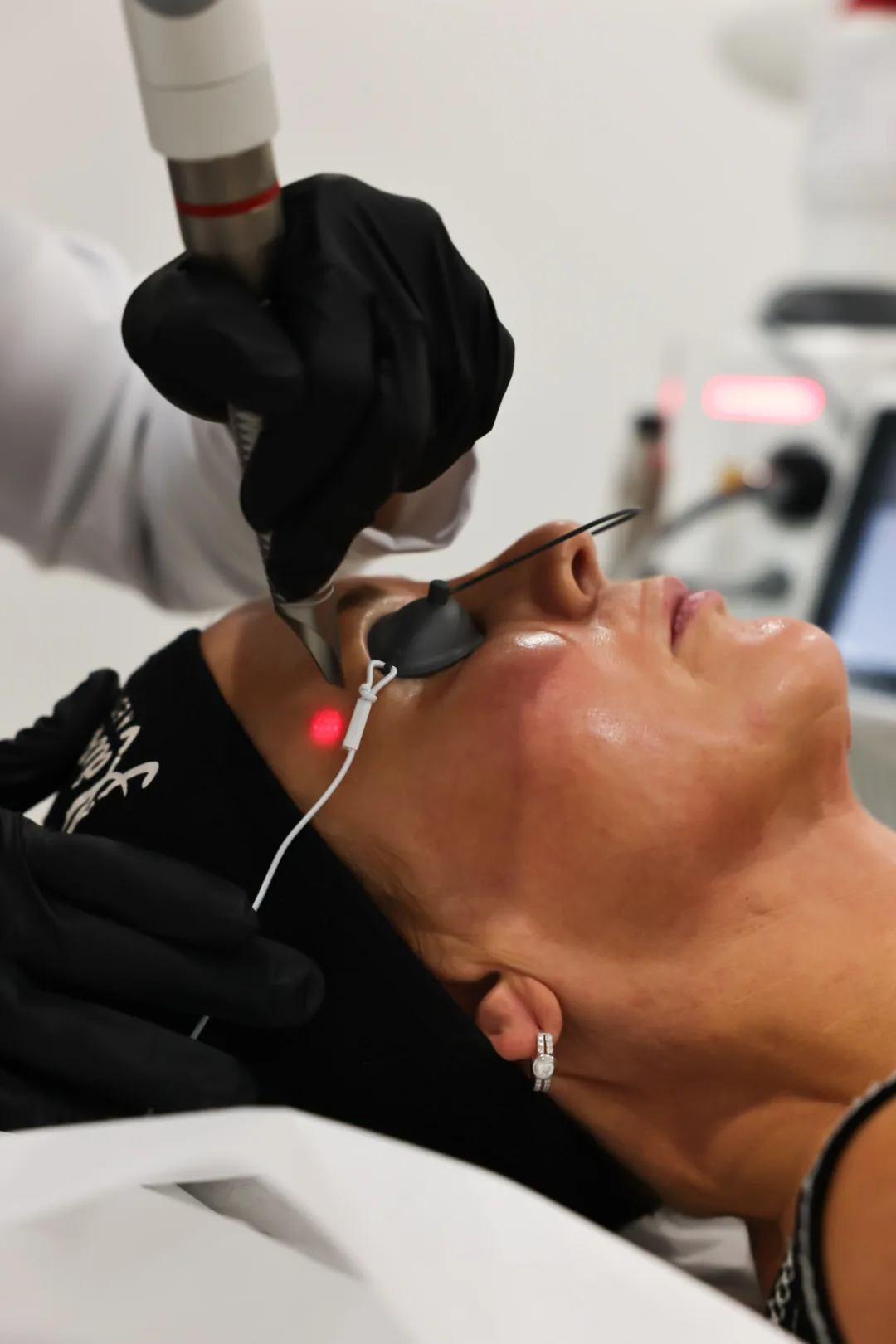 Facial laser treatment at Advanced Aesthetics