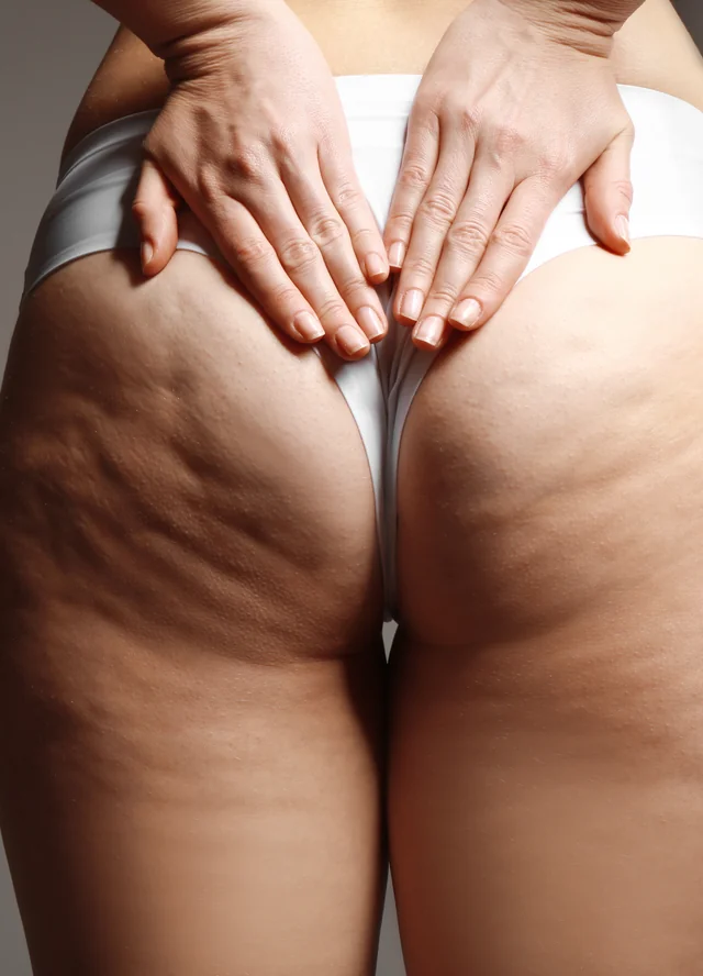 Close view of cellulite on a woman's thighs