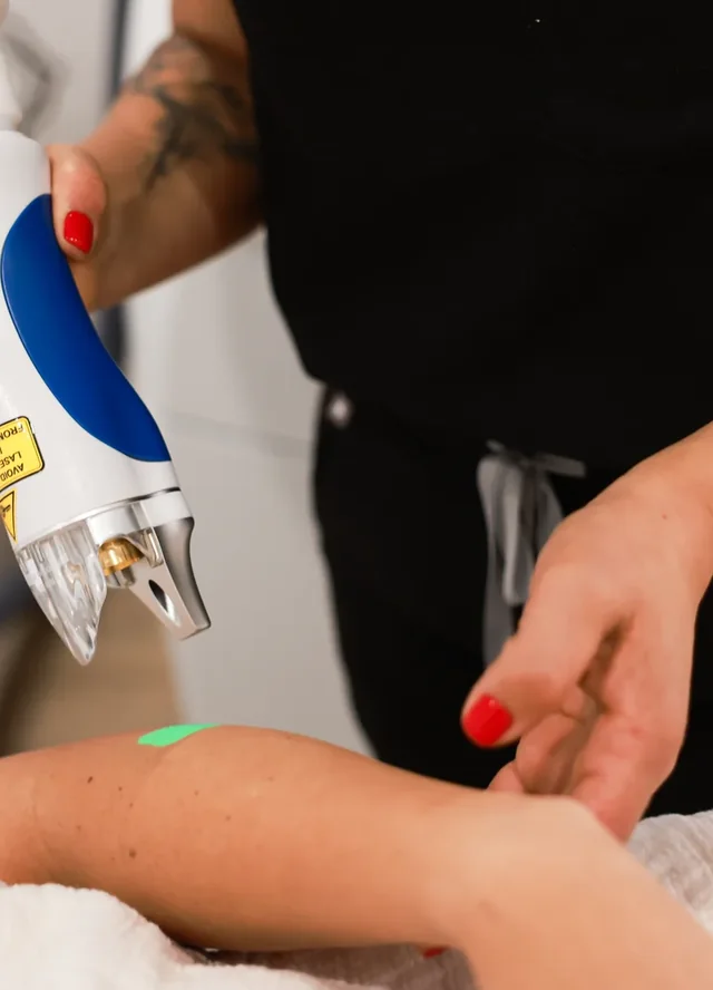 Splendor X laser hair removal treatment at Advanced Aesthetics