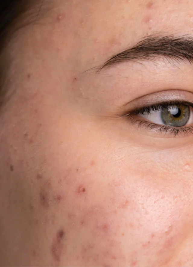 Close view of acne scarring on a woman's cheek