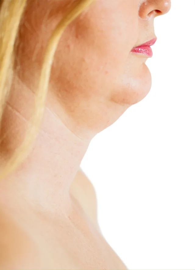 Profile showing fullness beneath a woman's chin