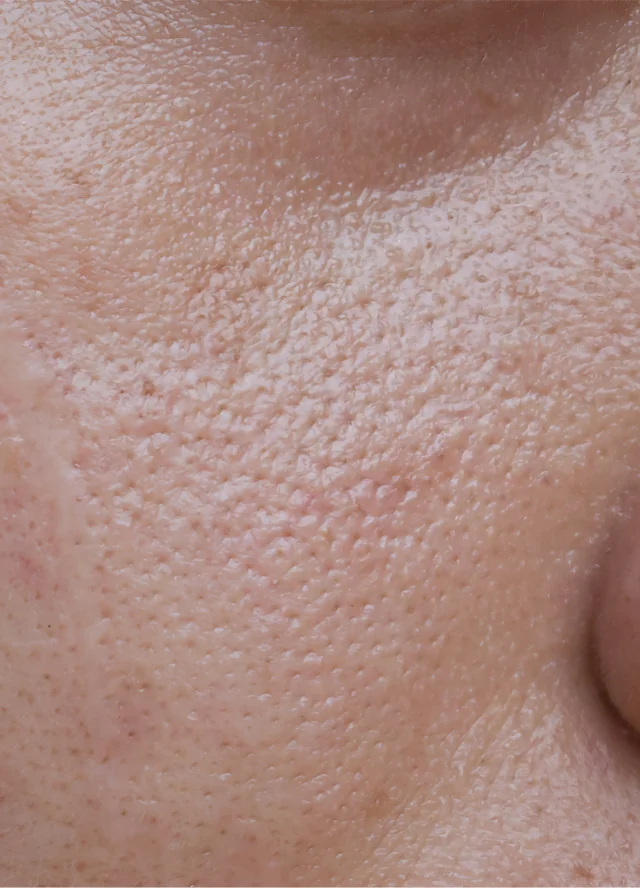 Close view of skin texture and pores on a cheek