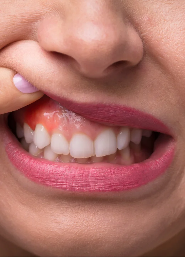 Close view of a smile showing upper gums