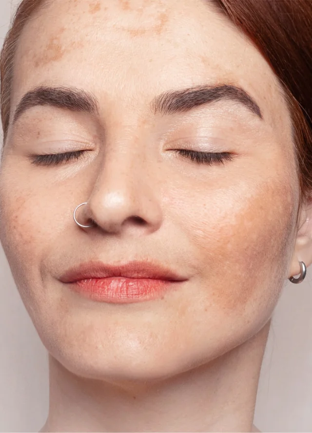 Woman with uneven pigmentation on her face