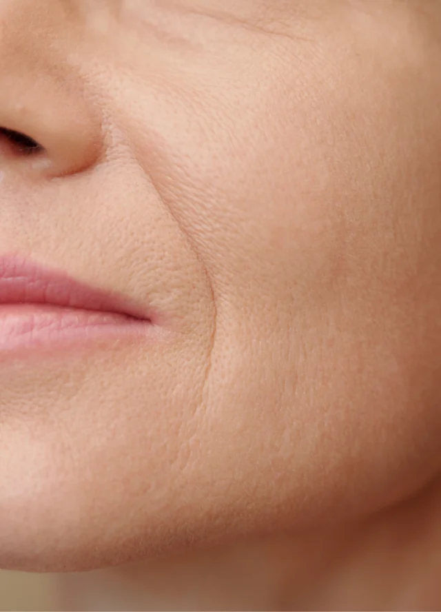 Close view of smile lines around a woman's mouth