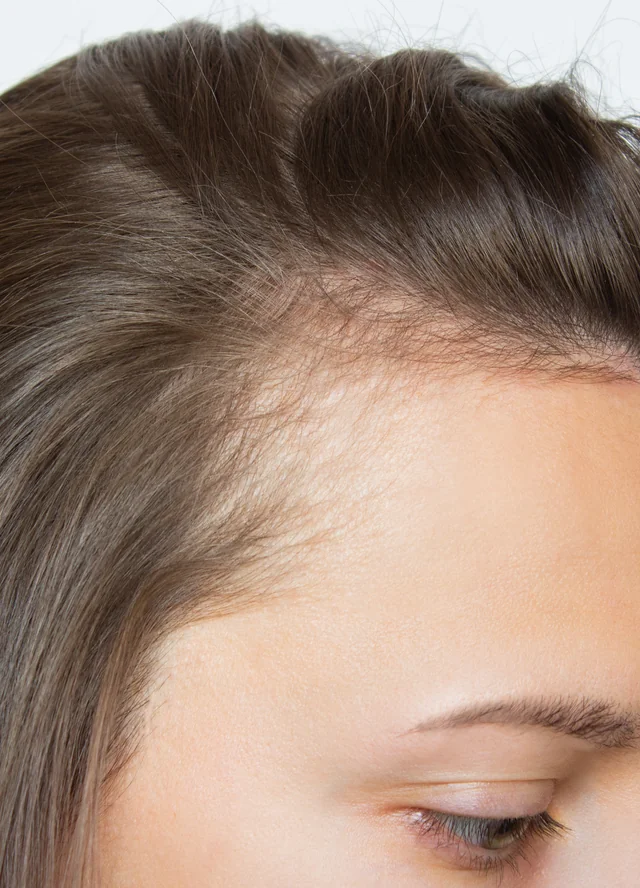 Close view of a woman's thinning hairline