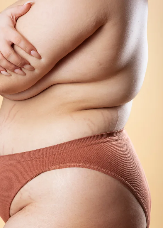 Localized fat on the abdomen and hips