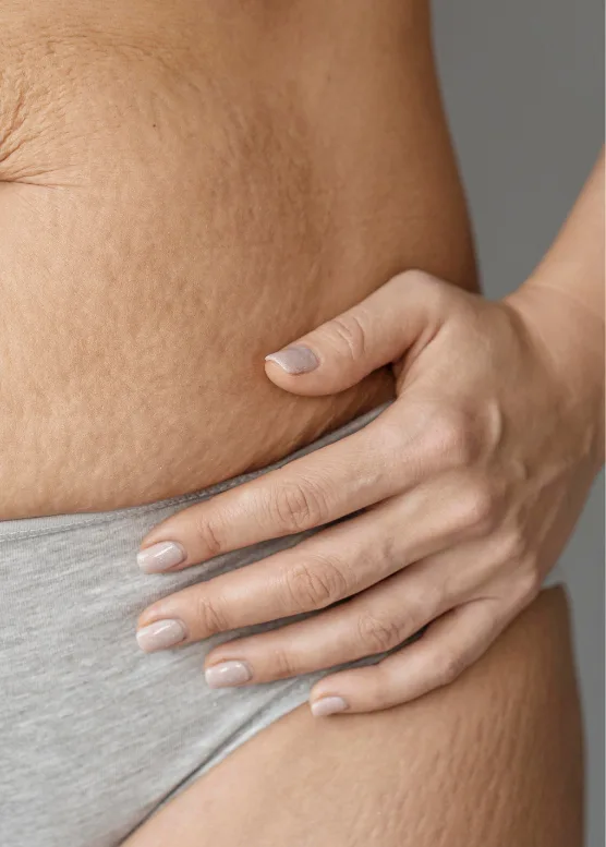 Stretch marks on the hip and abdomen