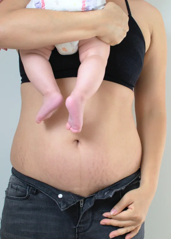 New mother holding her baby, post-pregnancy skin changes