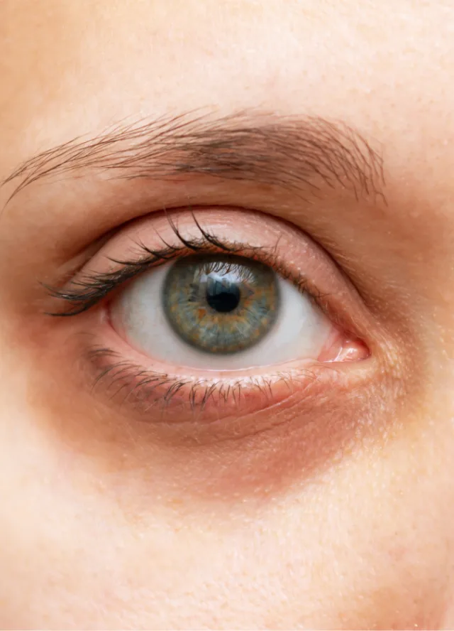 Close-up of dark circles under the eye
