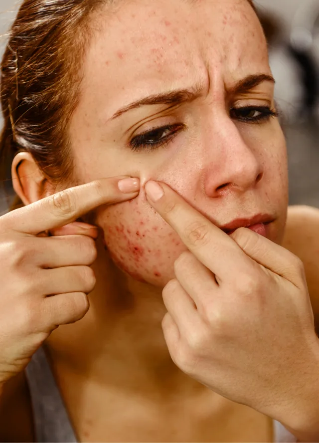 Woman checking active acne on her cheek