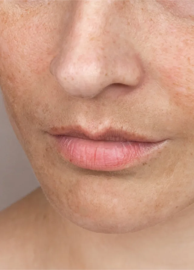 Close-up of uneven skin texture and enlarged pores