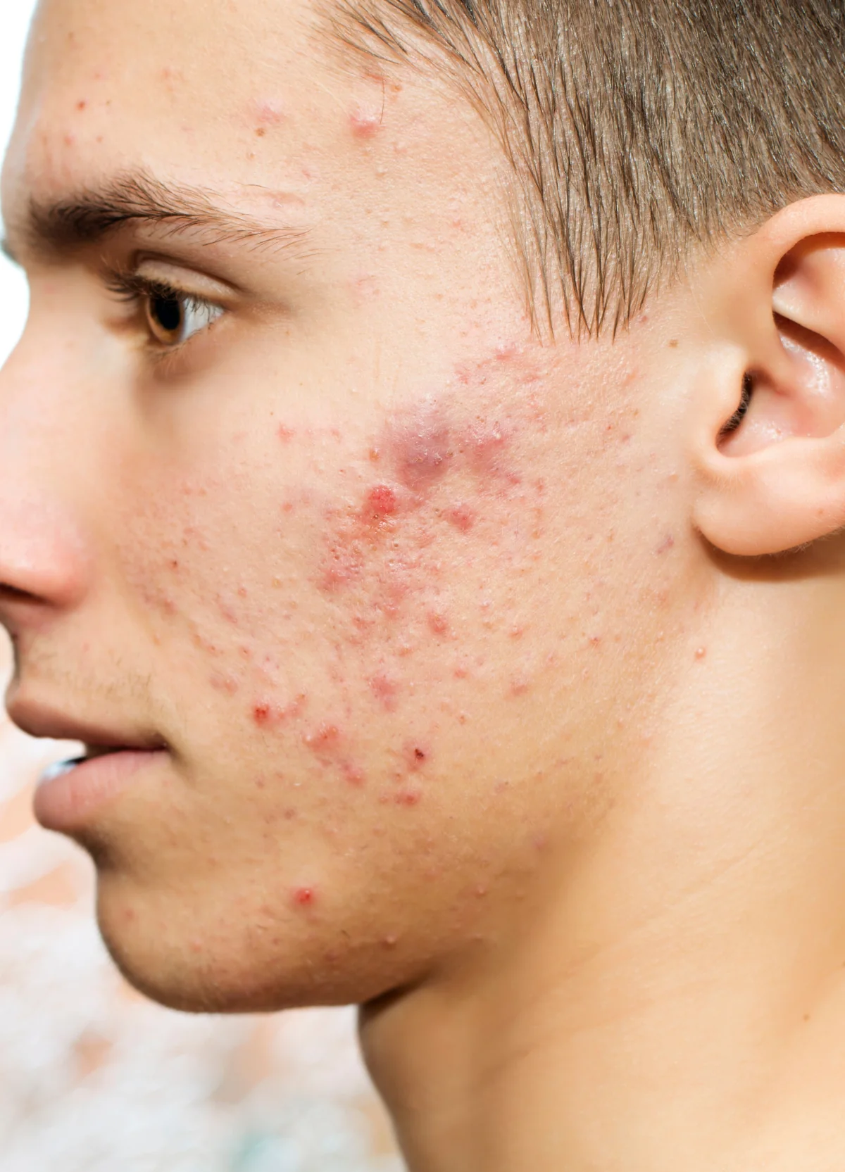 Close view of a male face with active acne