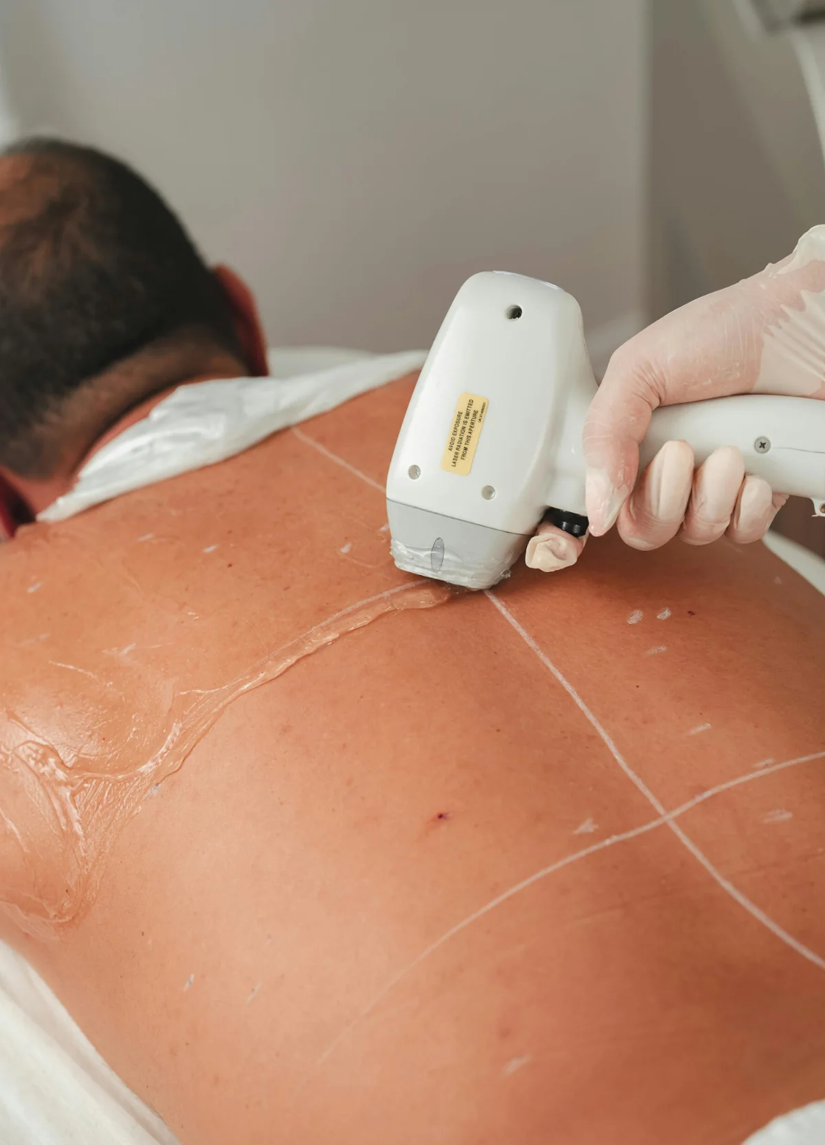 Man receiving a light-based treatment on his back