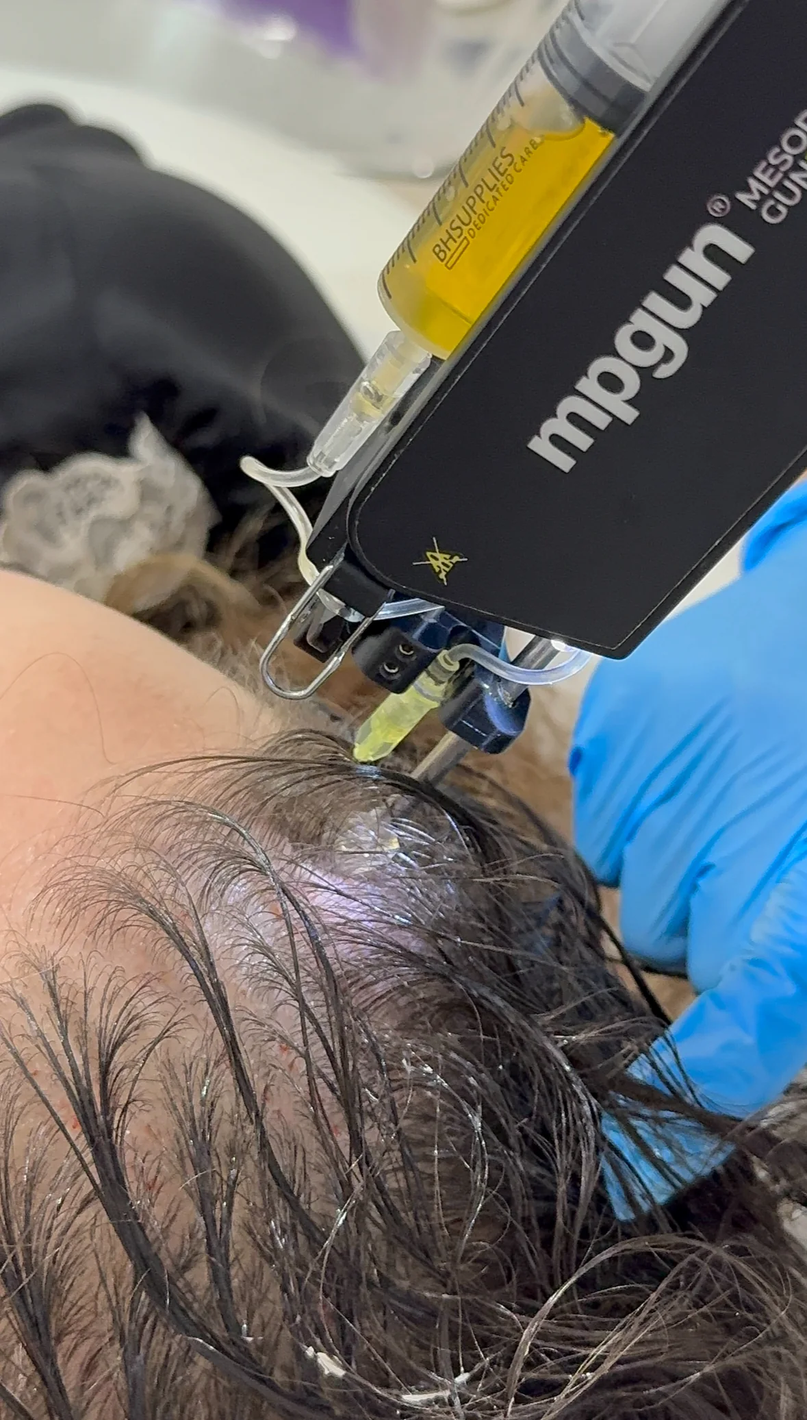 Scalp injection treatment at Advanced Aesthetics