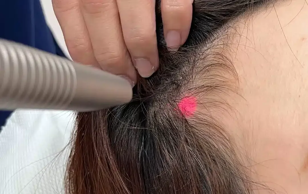 Fotona laser handpiece on the scalp during a hair restoration treatment