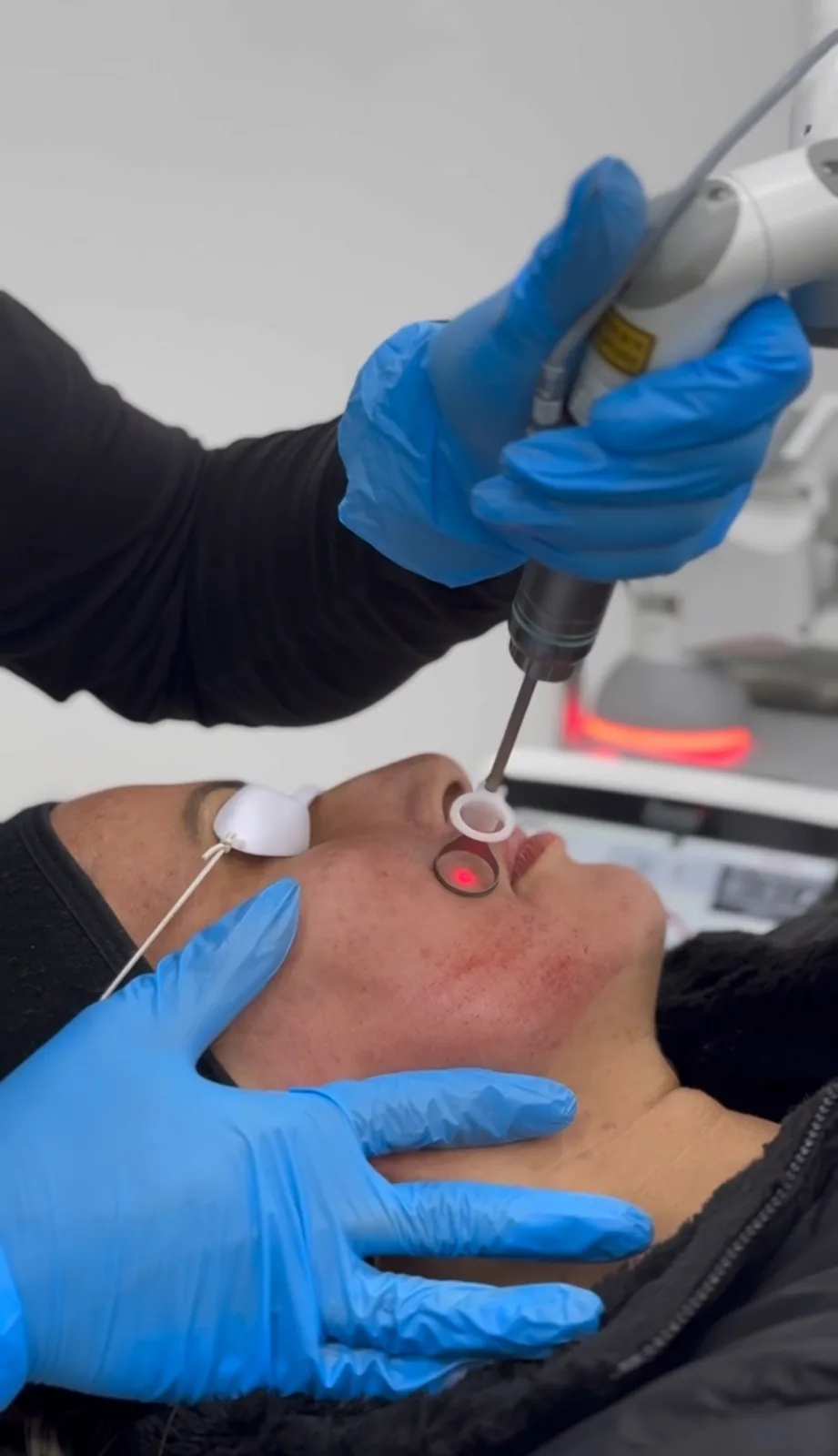 Fotona laser handpiece treating a patient’s face at Advanced Aesthetics