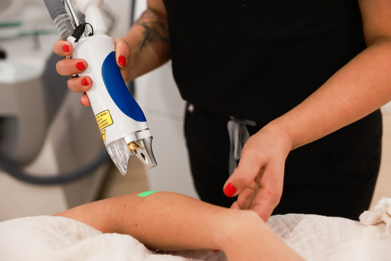 Splendor X laser hair removal on the arm at Advanced Aesthetics, Medford and Braintree MA