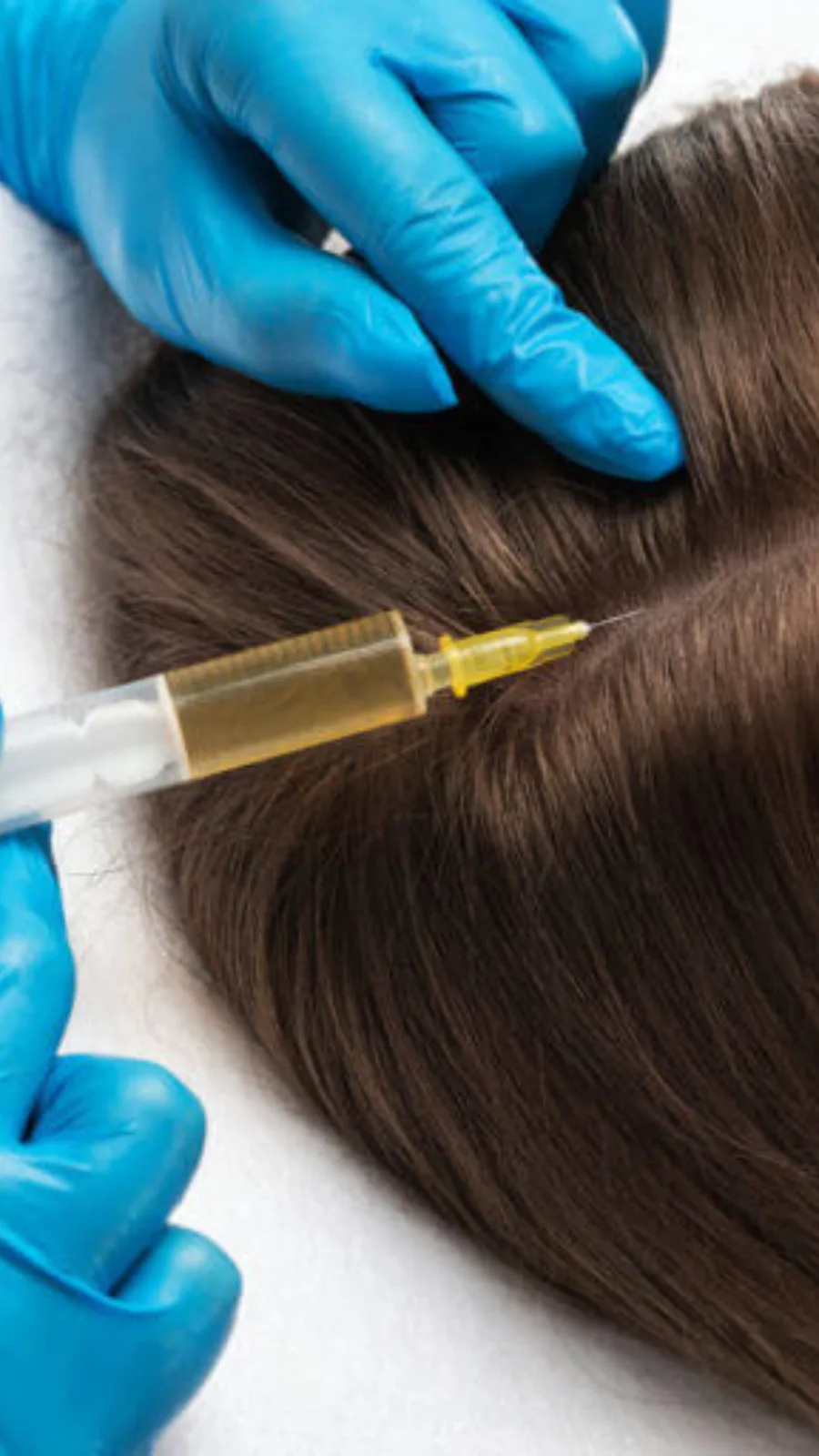 PRFM injected along the hair part for hair restoration at Advanced Aesthetics