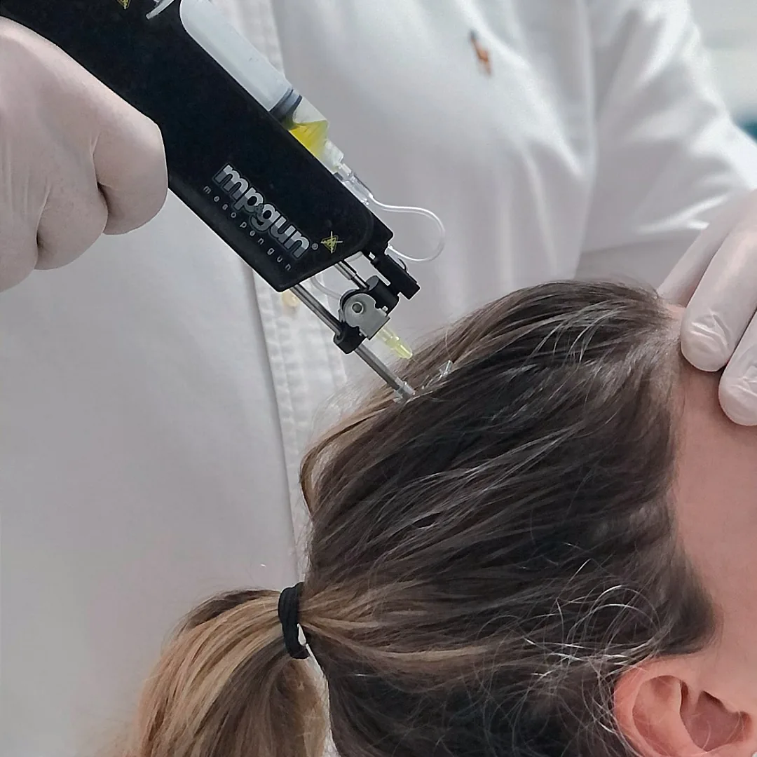 PRFM hair restoration injection into the scalp at Advanced Aesthetics, Medford and Braintree MA