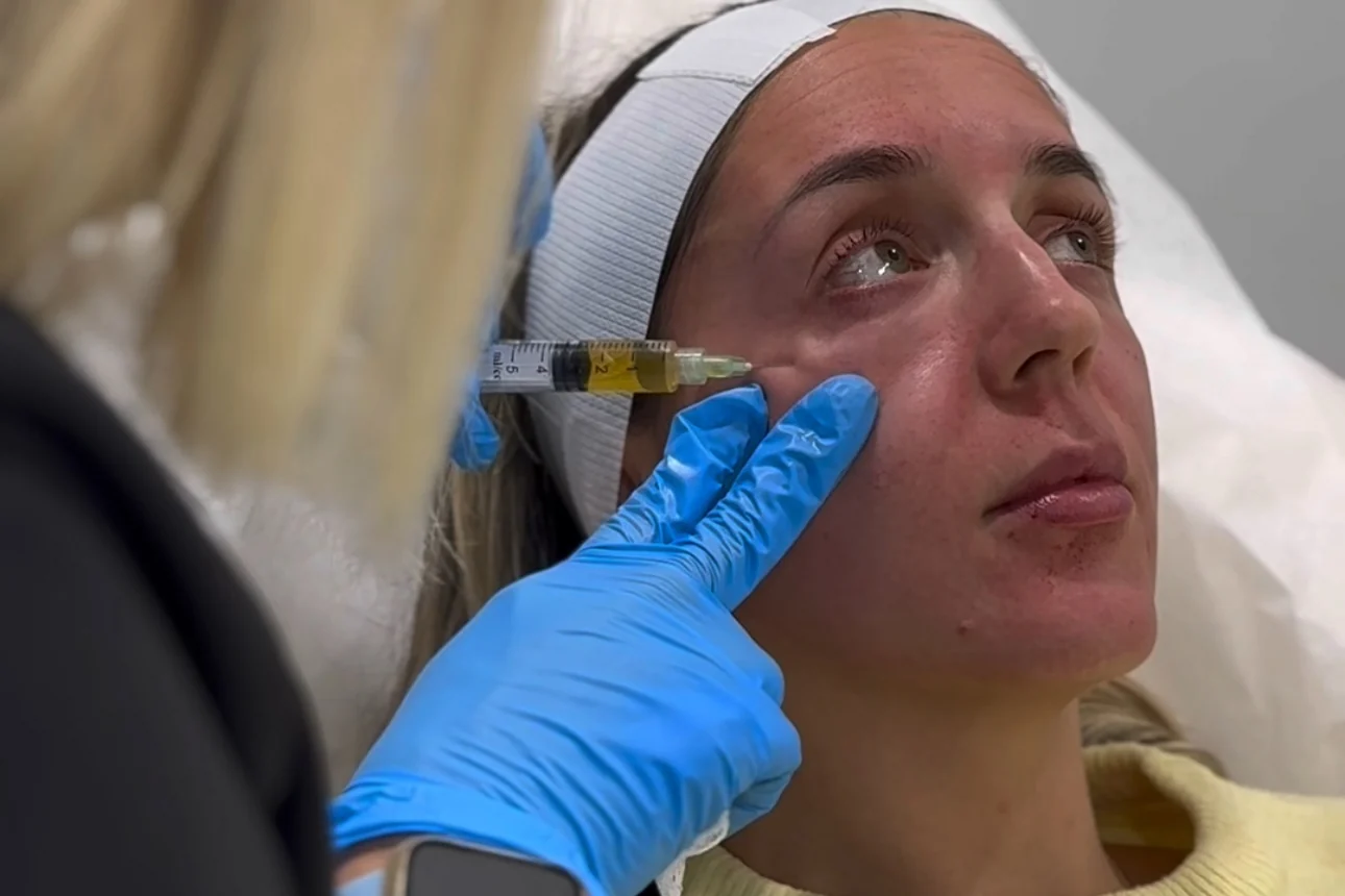 PRP injection beneath a patient’s eye at Advanced Aesthetics, Medford and Braintree MA