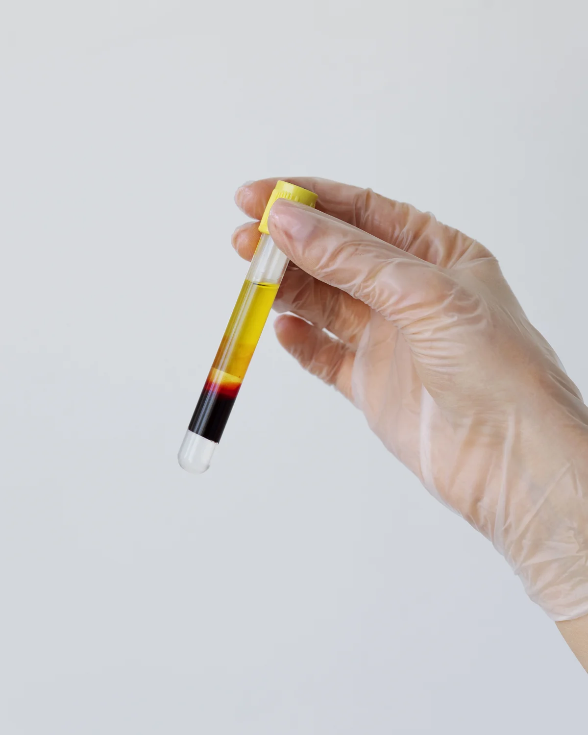 Platelet-rich plasma tube held by a gloved hand