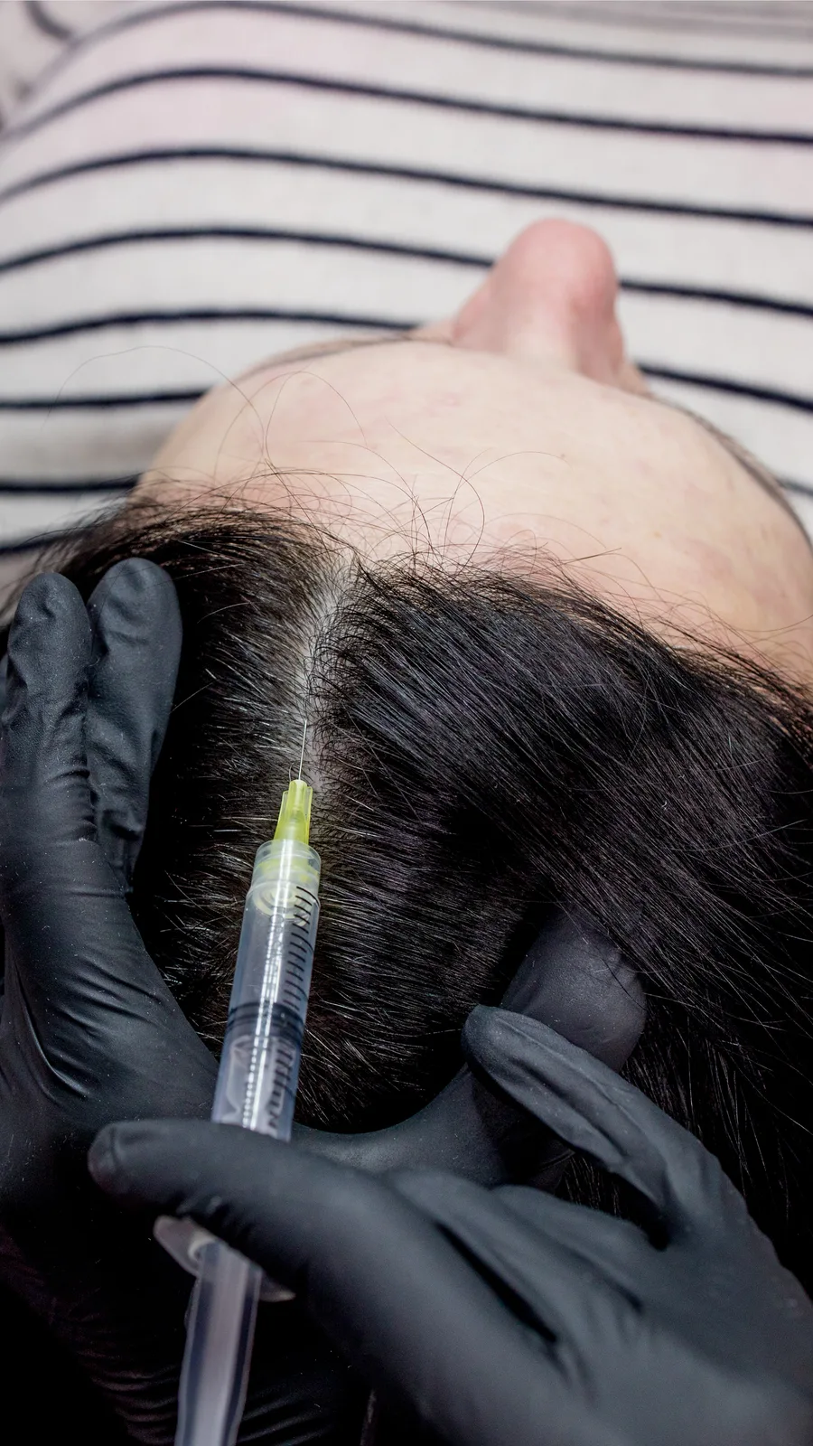 Scalp treatment along the part line for hair restoration